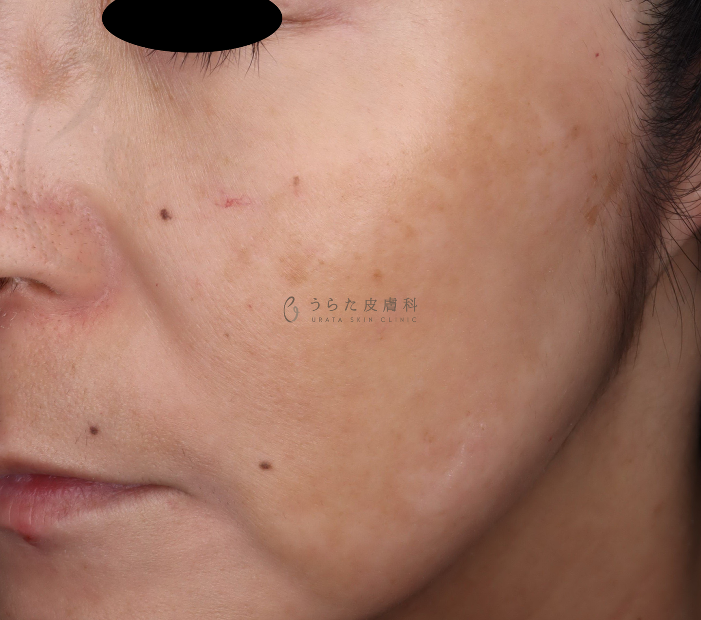 肝斑のトレチノイン治療４週間後