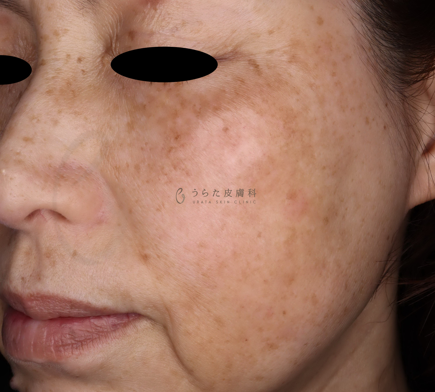 ピコレーザー治療前