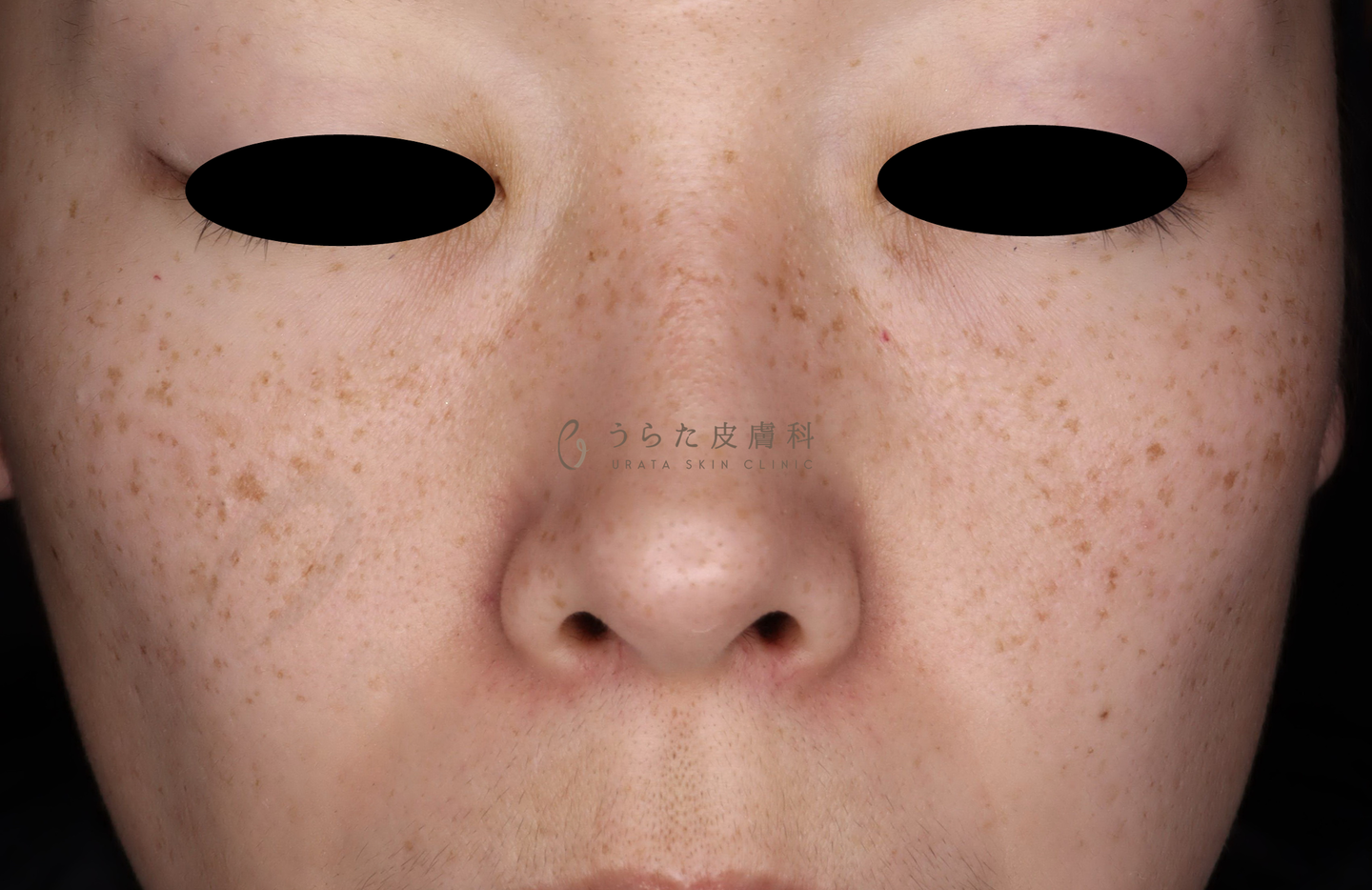 そばかすのルメッカ治療1回後そばかすのルメッカ治療前