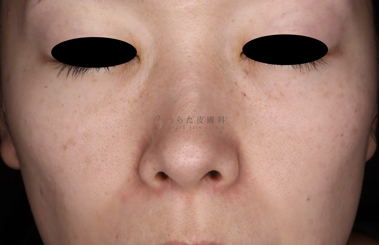 そばかすのルメッカ治療1回後