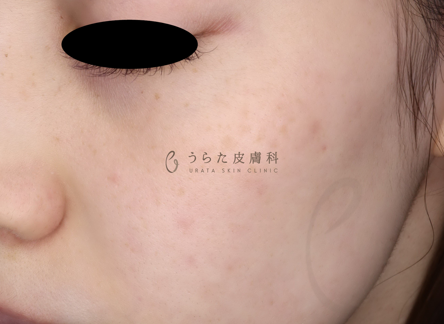 そばかすのルメッカ治療2回後