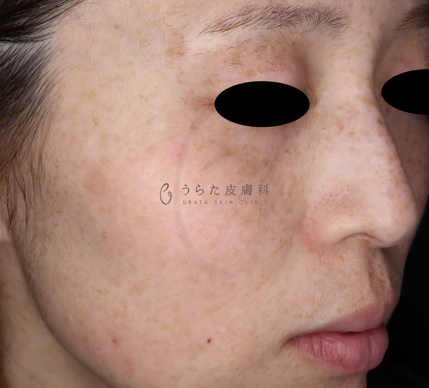 ルメッカ治療前