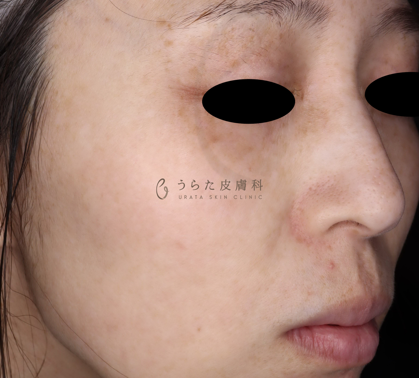 ルメッカ治療４回後