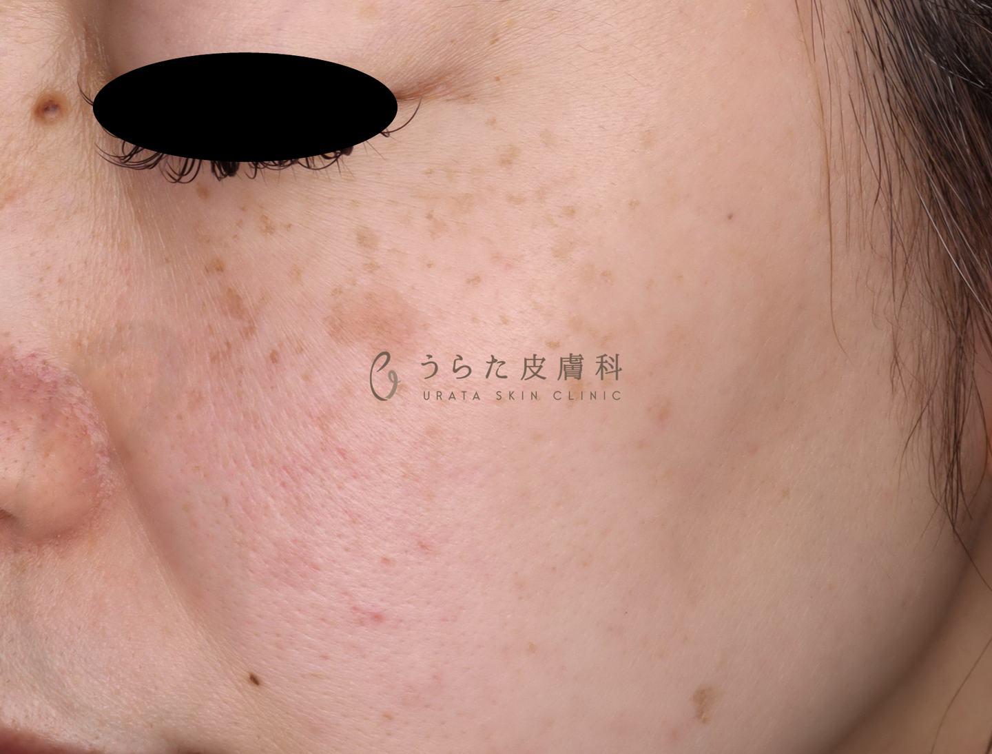 シミのルメッカ治療前