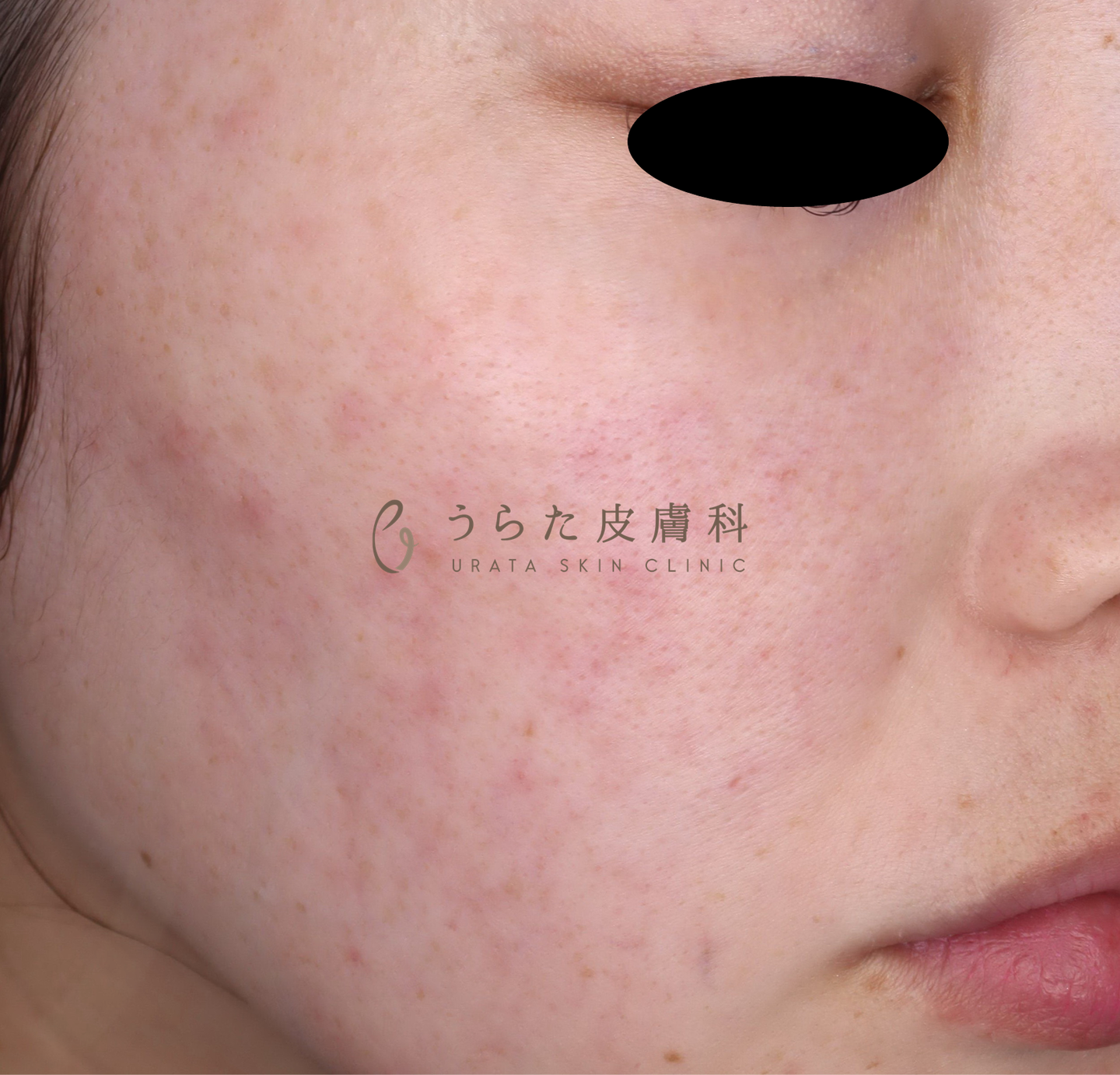 赤ら顔のルメッカ治療前