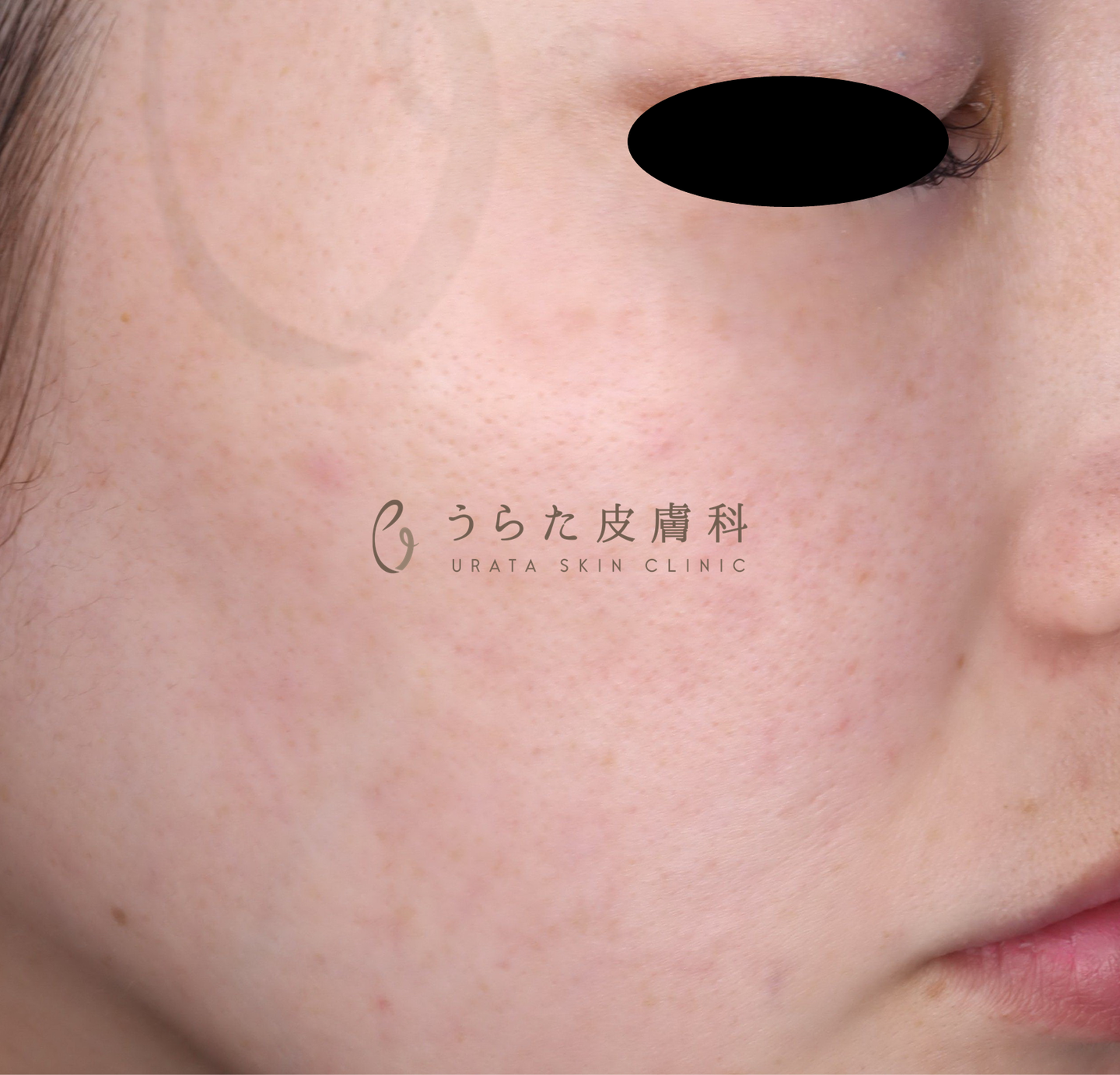 赤ら顔のルメッカ治療1回後