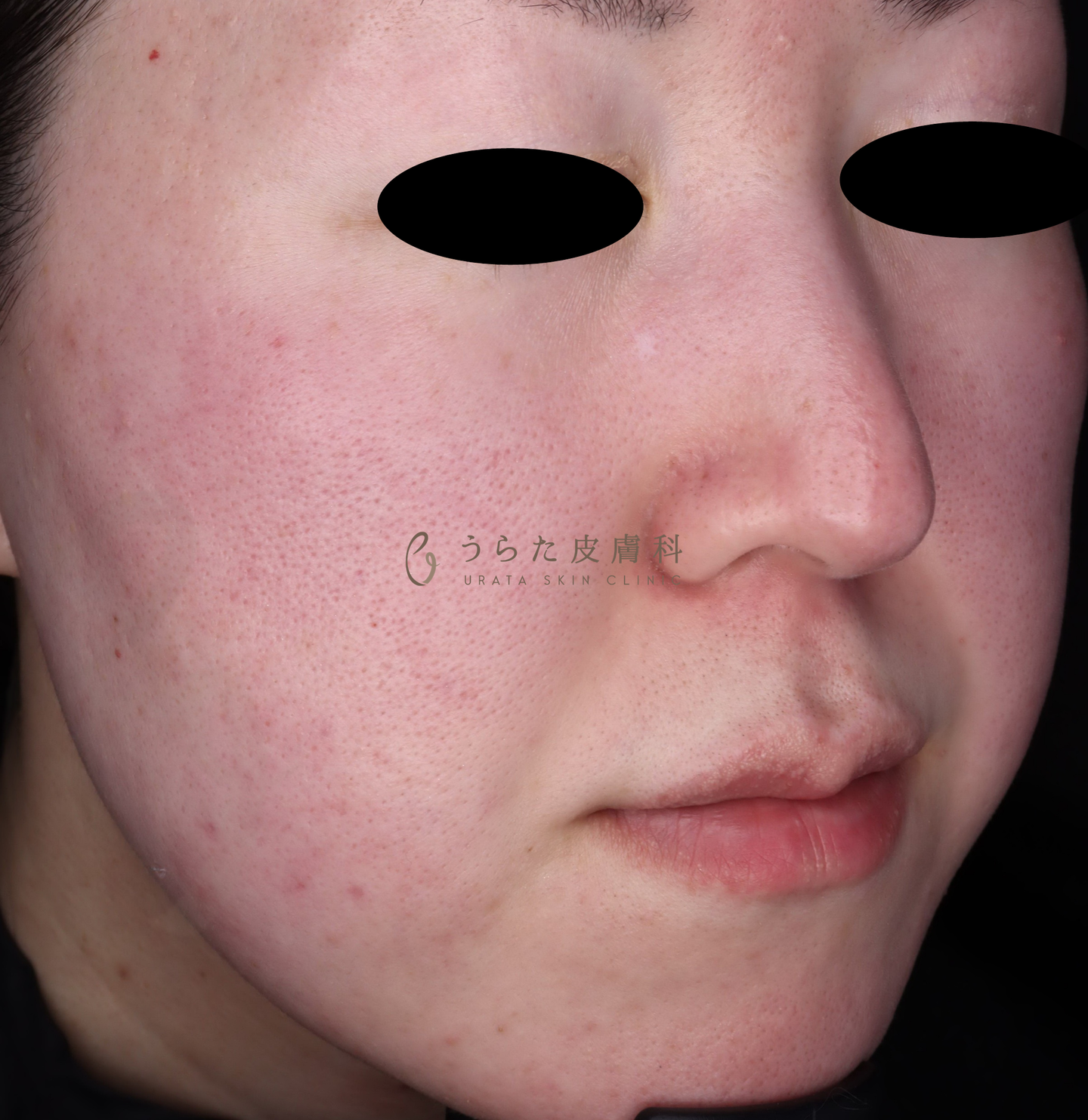 赤ら顔のルメッカ治療前