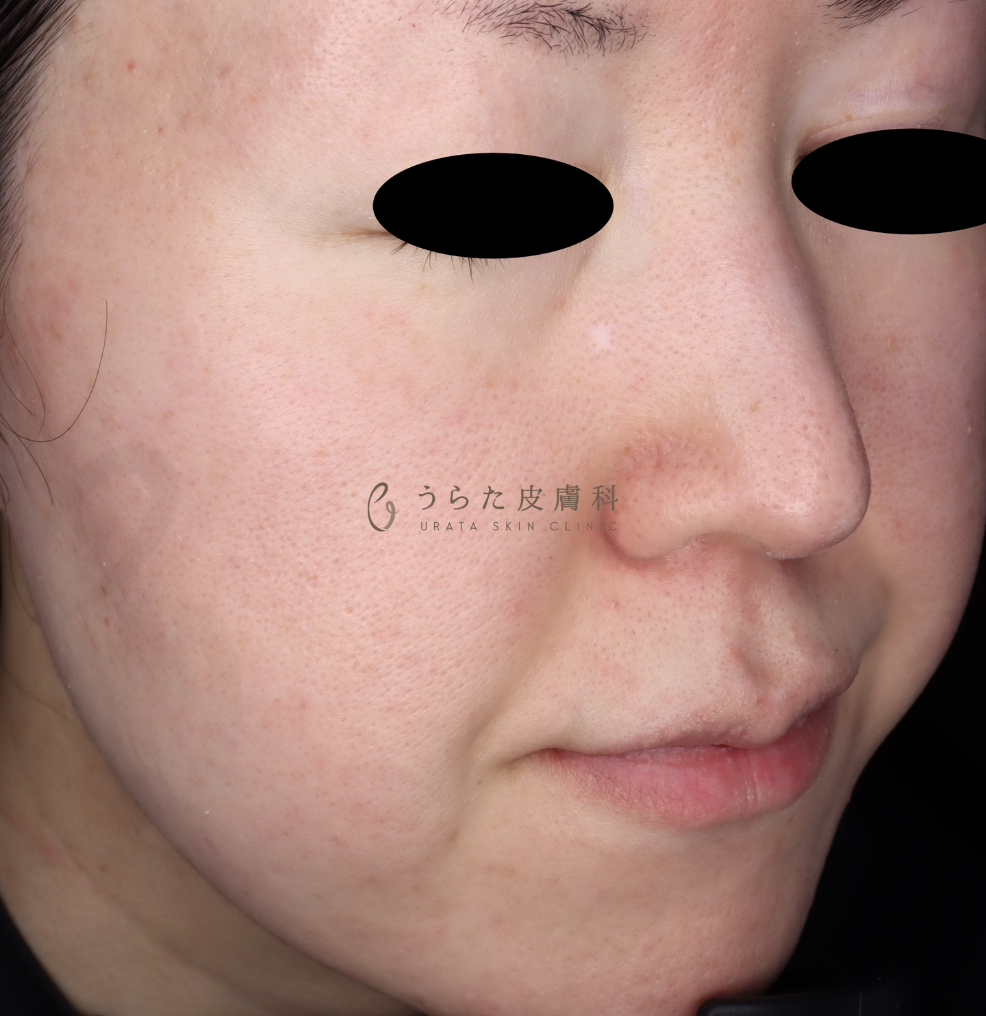 赤ら顔のルメッカ治療3回後