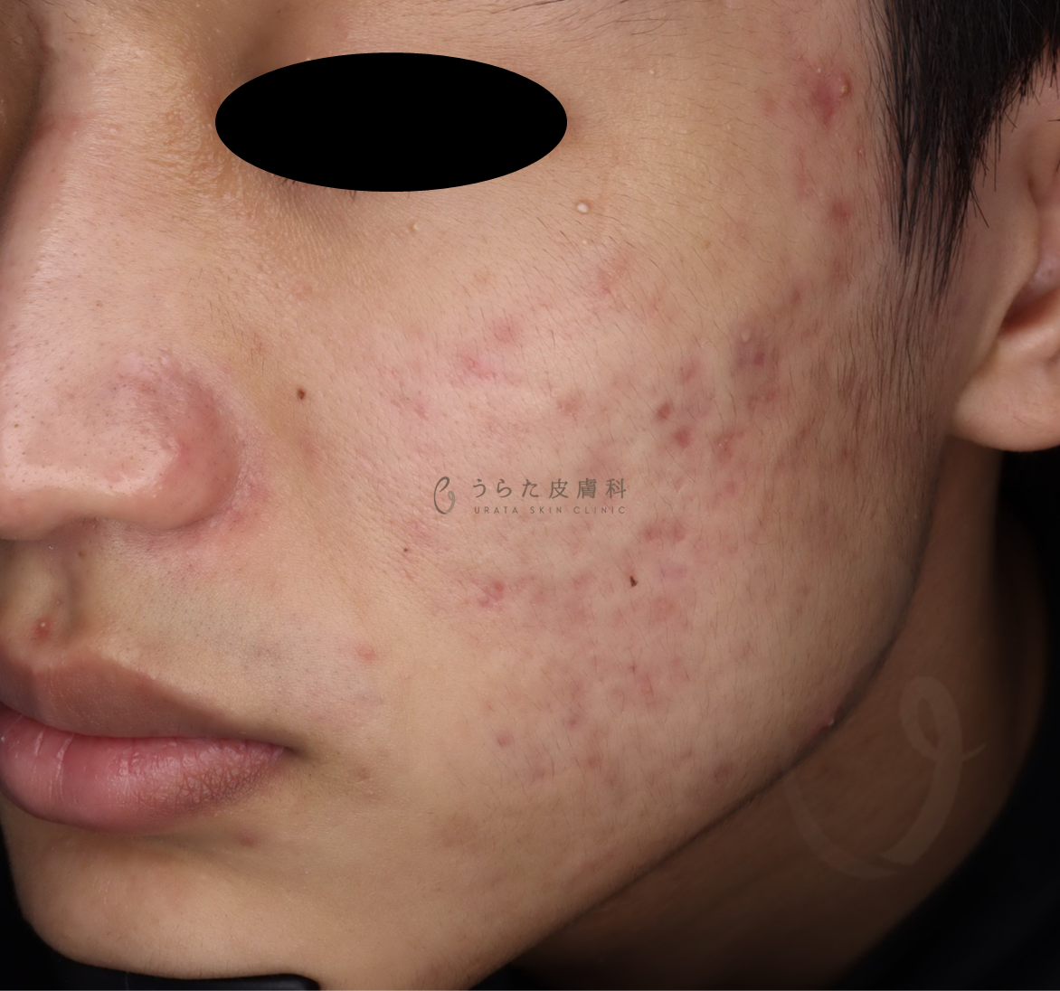 キュアジェット治療前