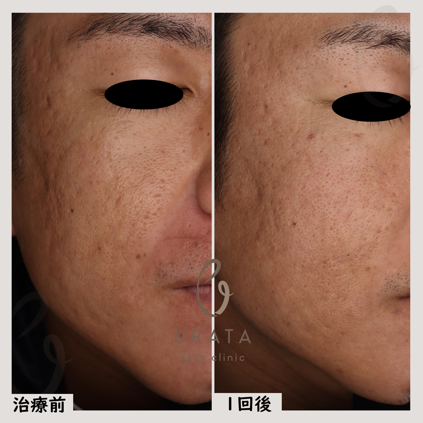 キュアジェットによるニキビ跡治療