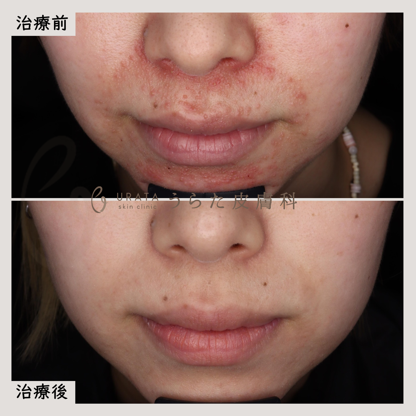 口囲皮膚炎の治療経過１