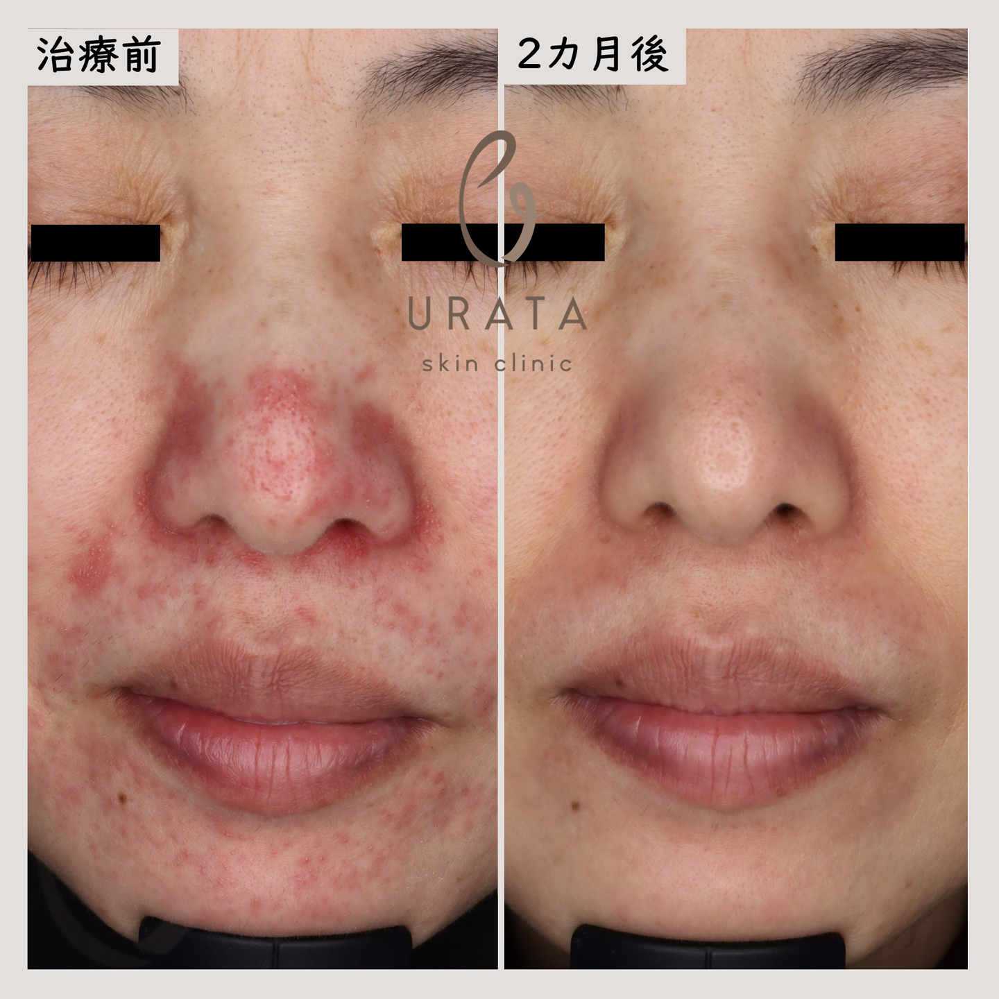 口囲皮膚炎の治療経過１