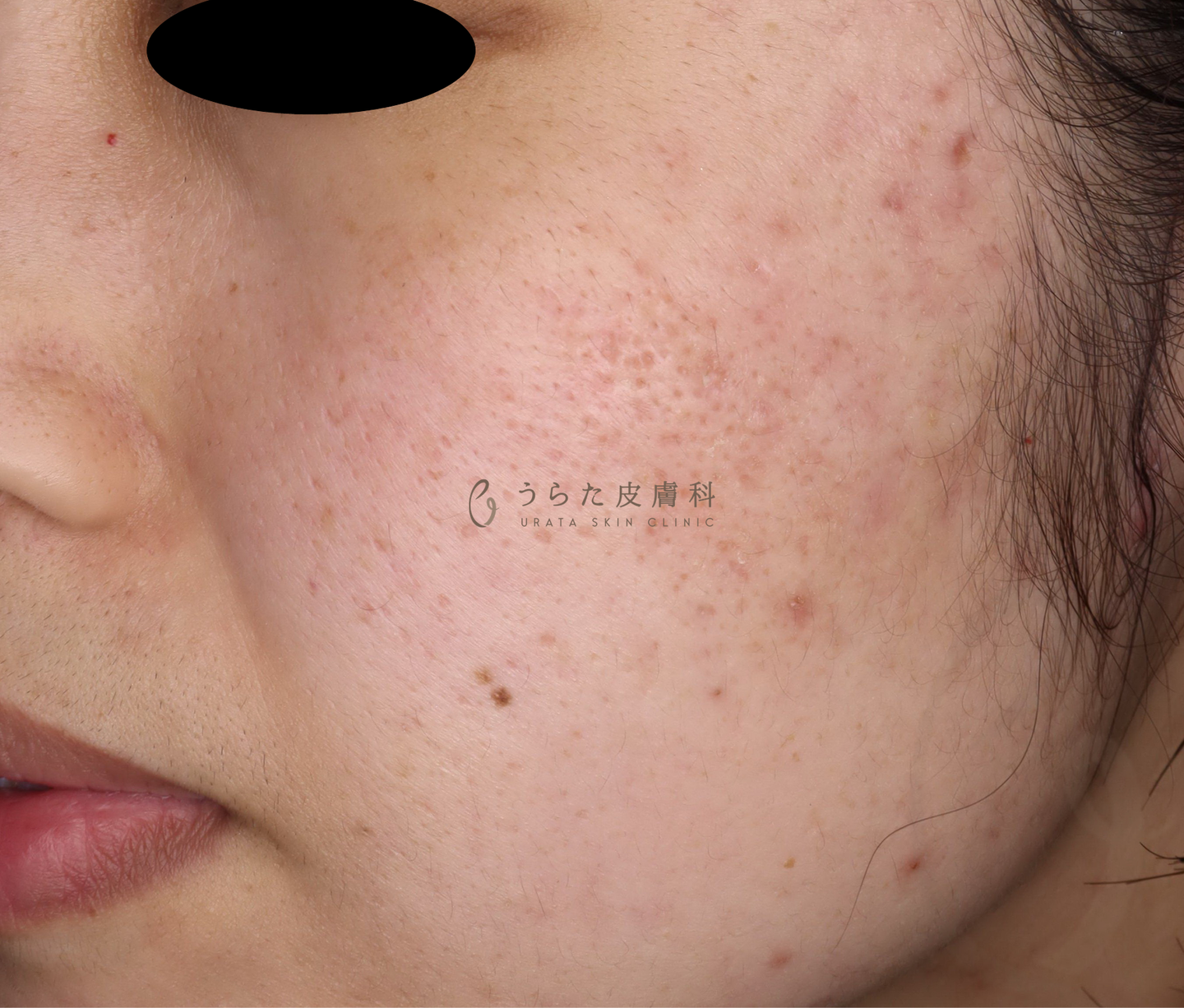 ニキビのポテンツァ治療前