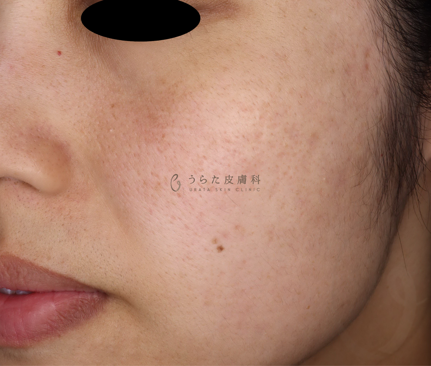 ニキビのポテンツァ4回後