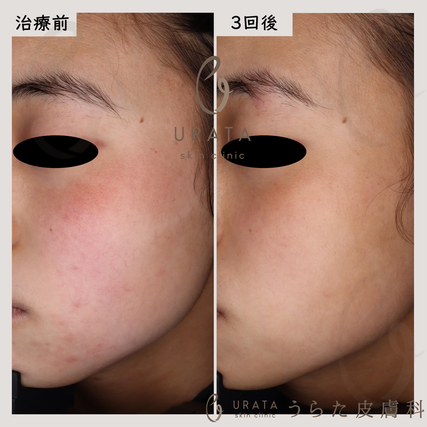 Vビームの毛細血管拡張症治療