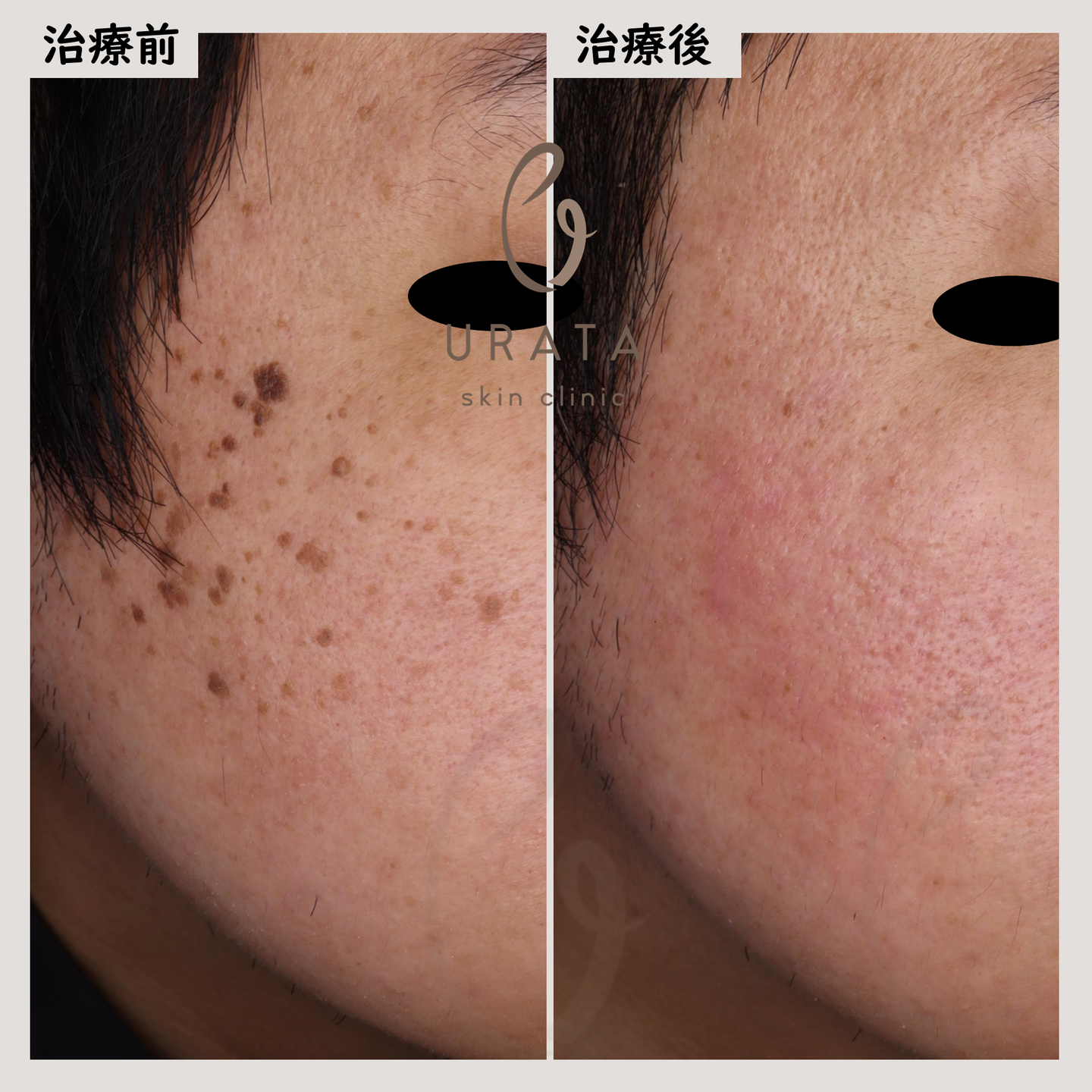 顔のイボの治療１