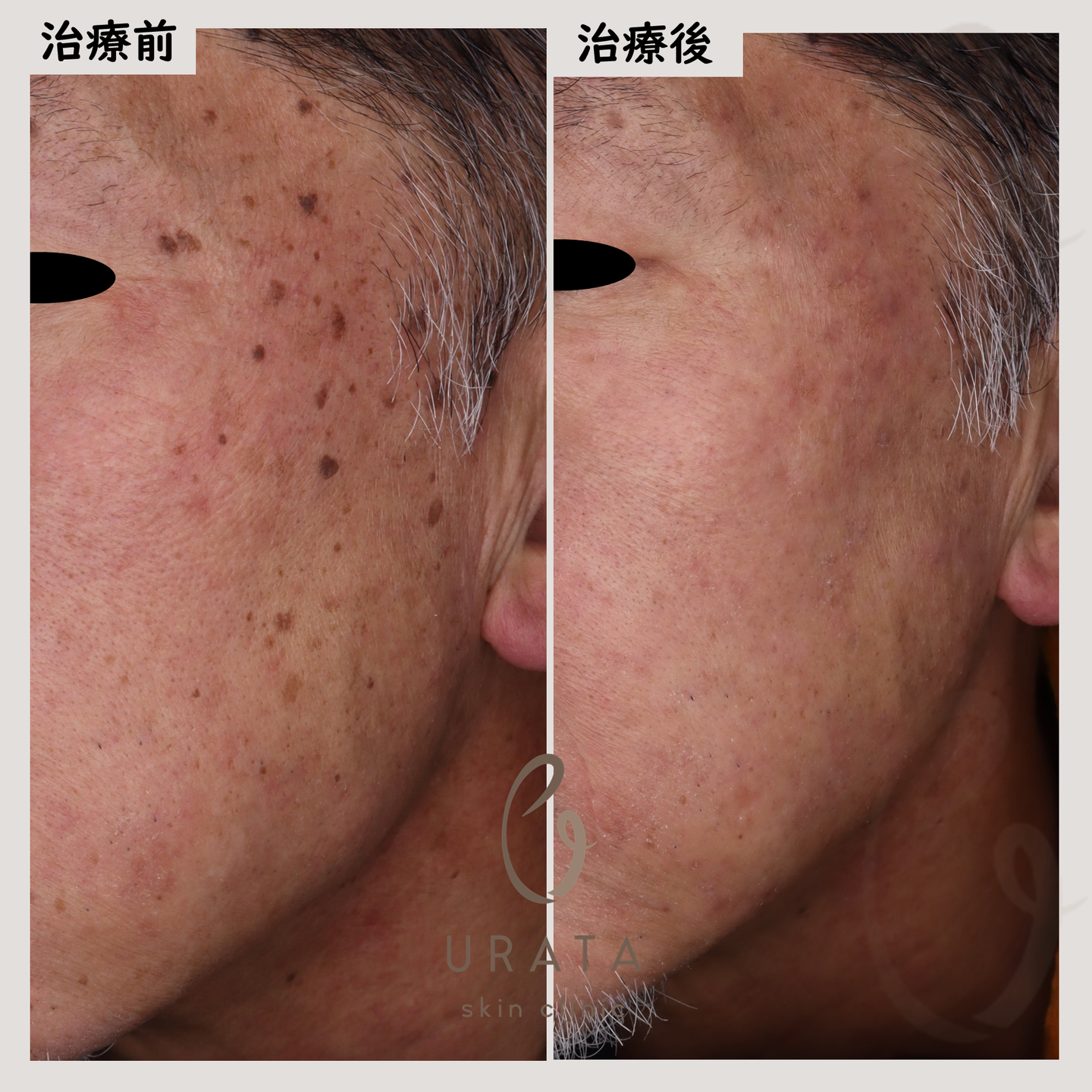 脂漏性角化症のピコレーザー治療