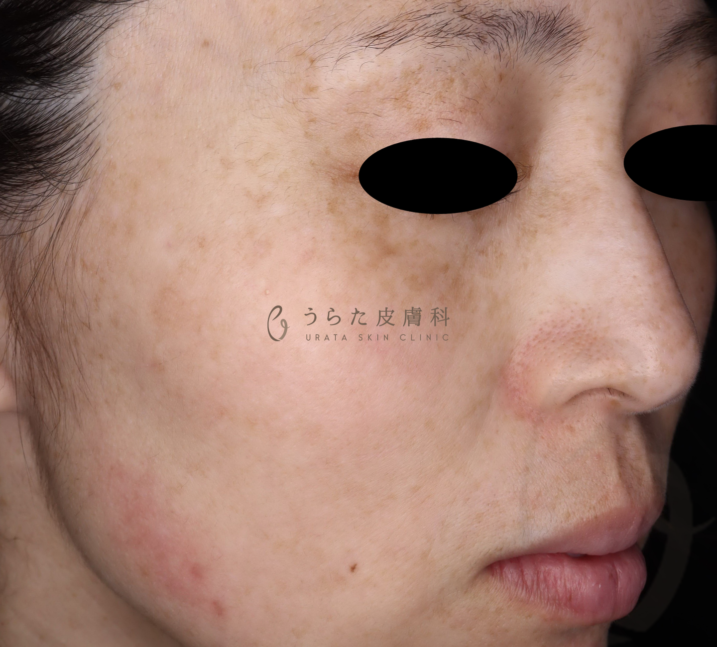 ルメッカ治療2回後