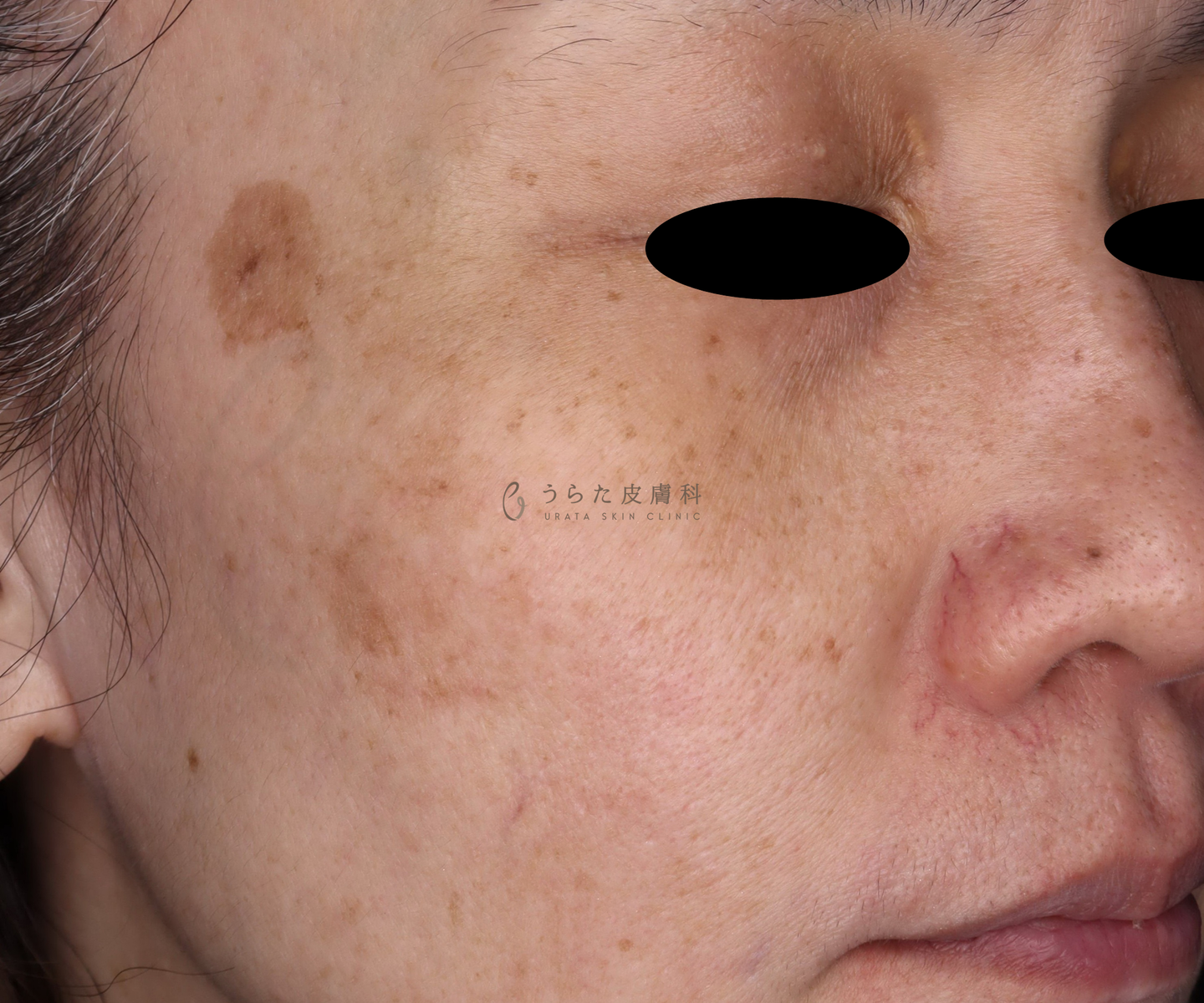 老人性色素斑・そばかすのピコトリプル治療前