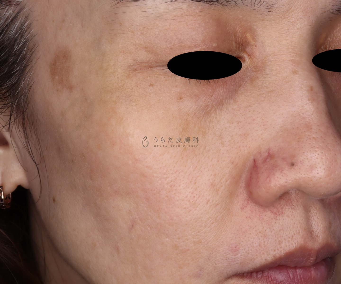 老人性色素斑・そばかすのピコトリプル治療2回後