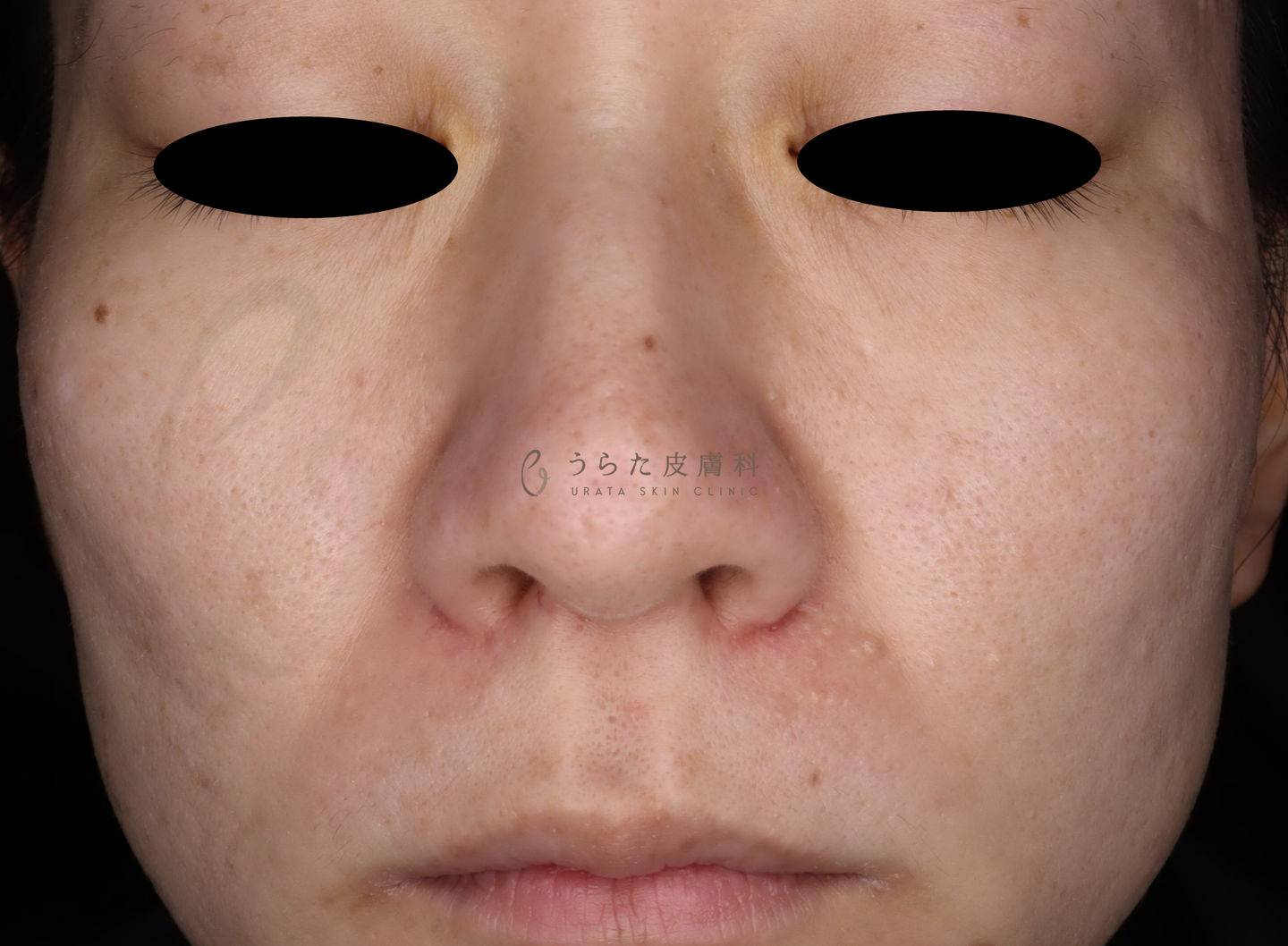 ピコトリプル2回後