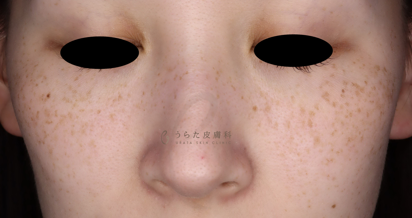 そばかすのルメッカ治療1回後そばかすのピコレーザー治療前