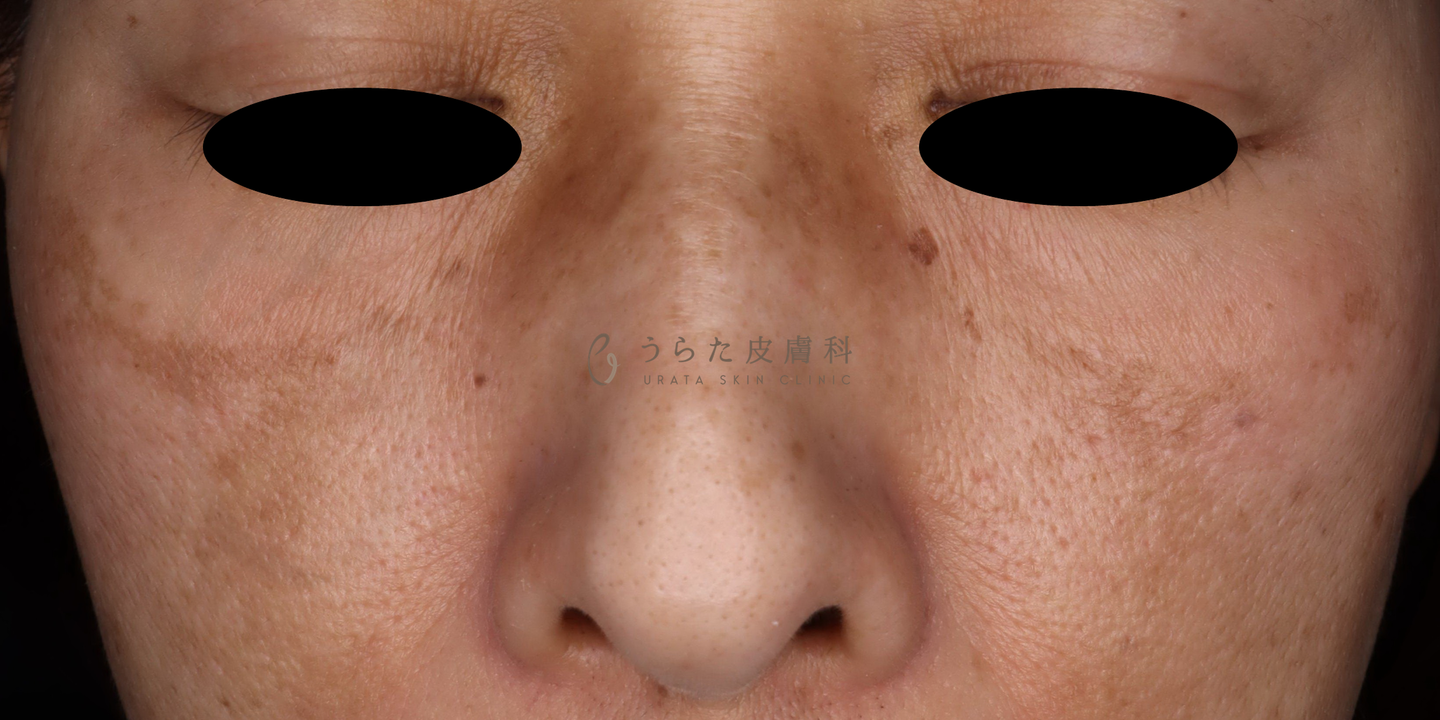 肝斑のゼオスキン治療2週間後