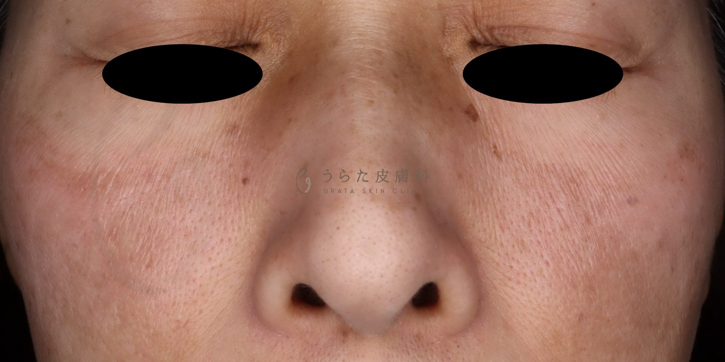 肝斑のゼオスキン治療6週間後