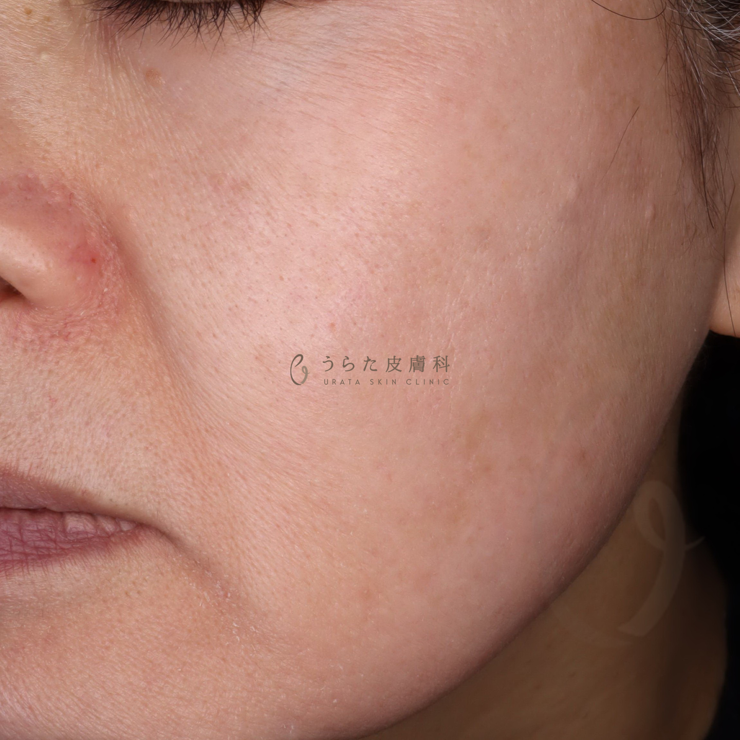 肝斑のゼオスキン治療後