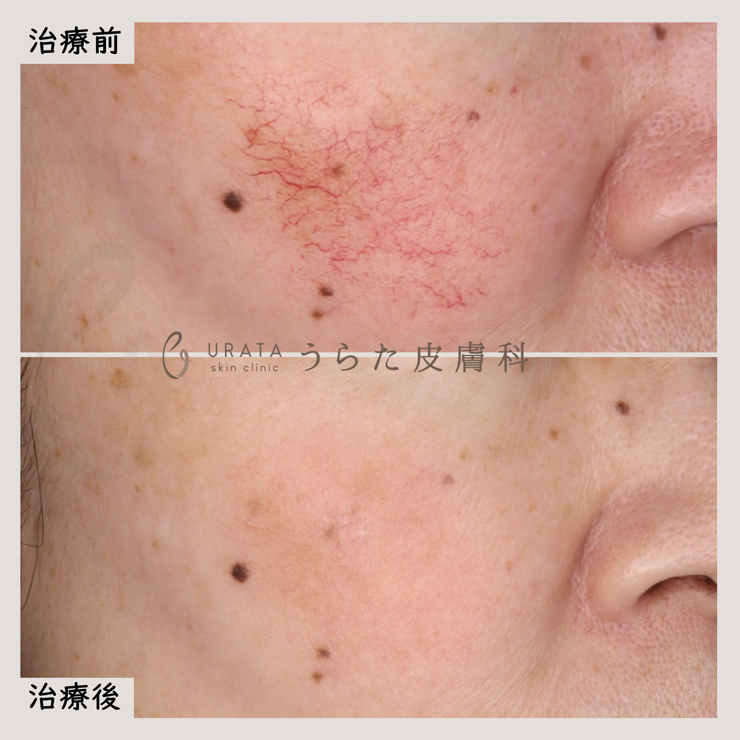 ブイビームによる毛細血管拡張の治療