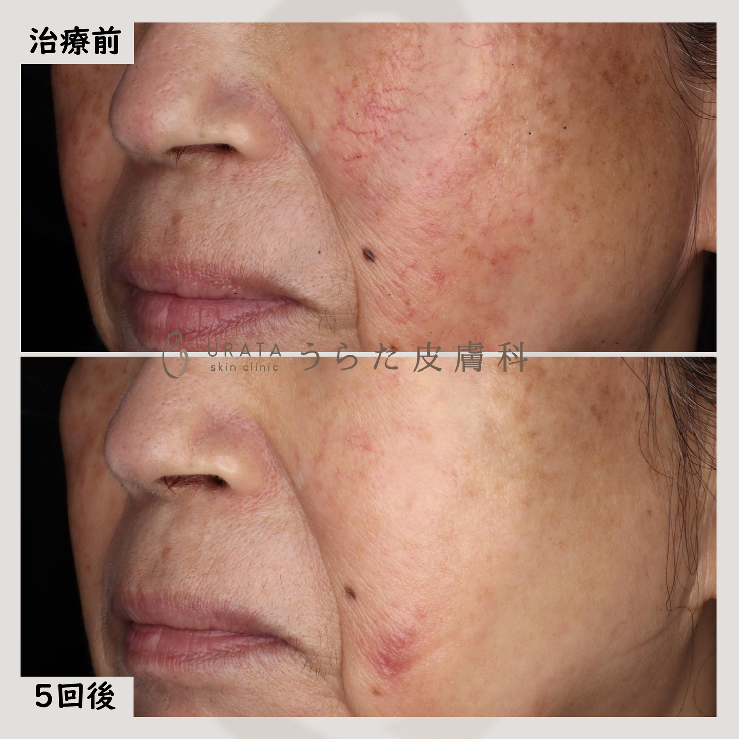 ブイビームによる毛細血管拡張の治療