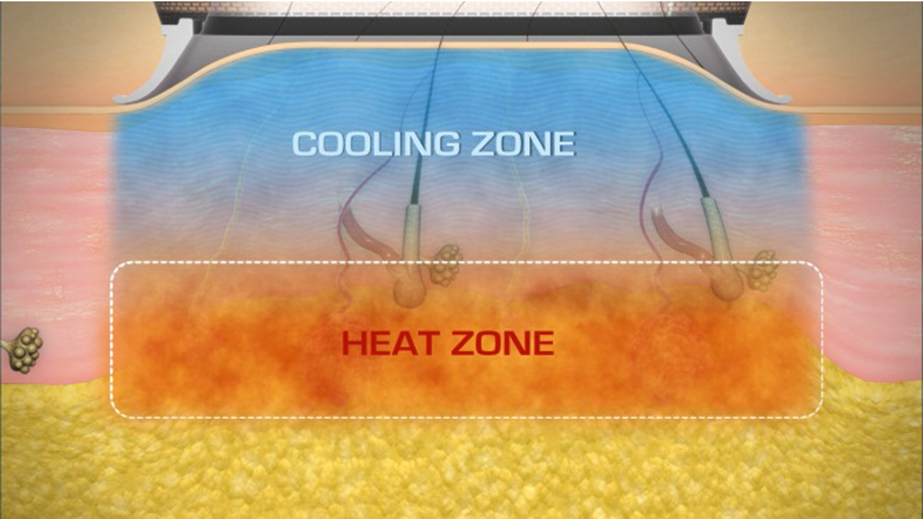 ミラドライのしくみ