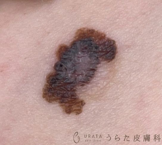 悪性黒色腫