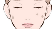 炎症後色素沈着のイラスト