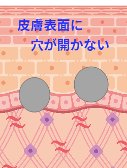 ダーマペンとフラクショナル治療の比較