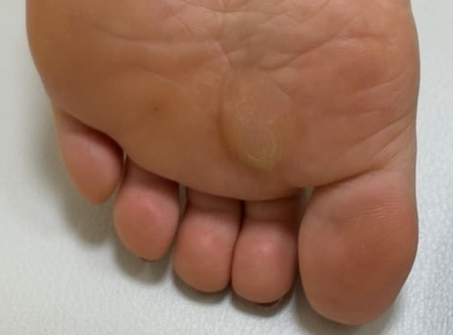 足底粉瘤の術前