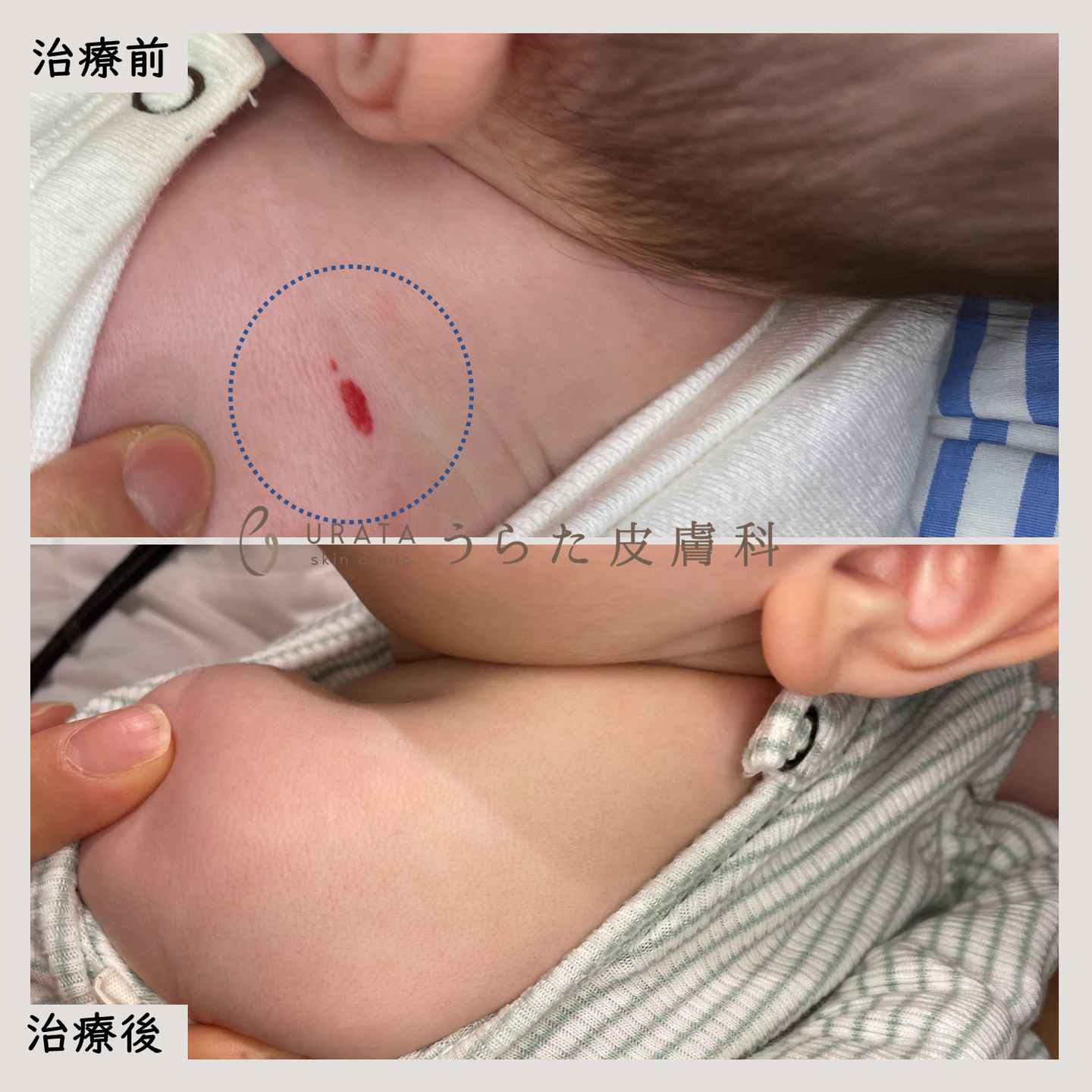 Vビームの乳児血管腫治療