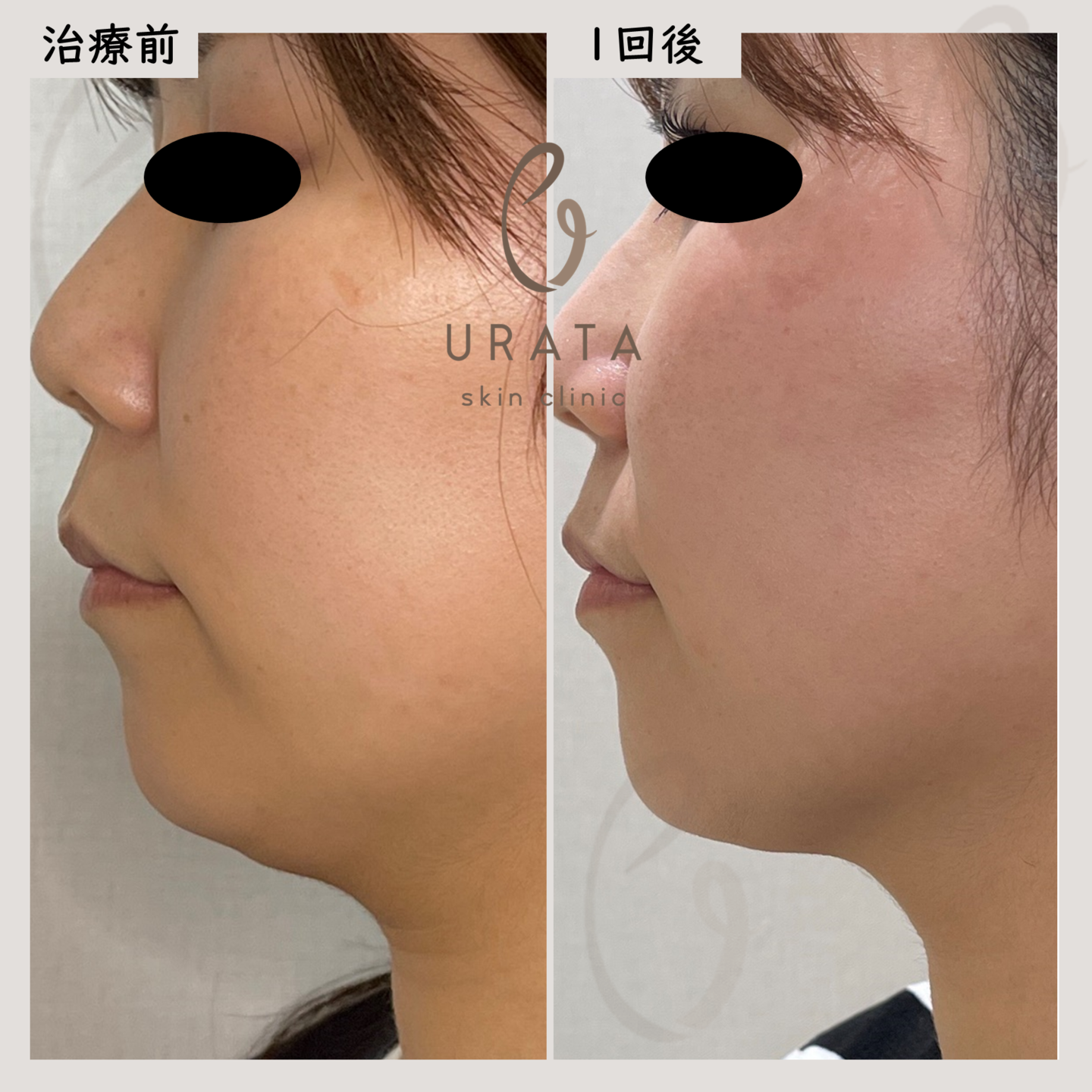 脂肪冷却の症例写真