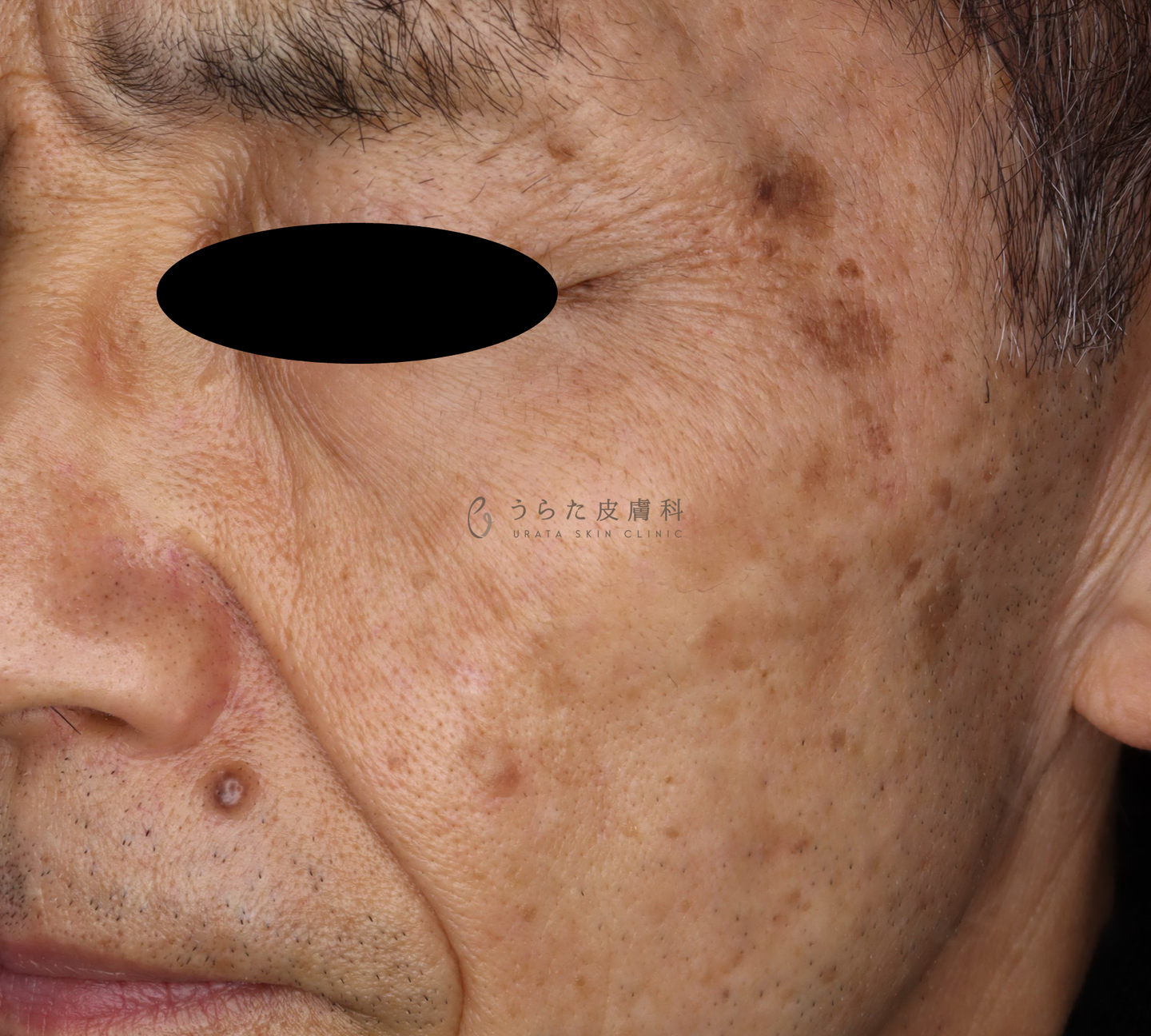 老人性色素斑