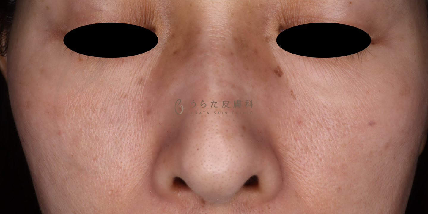 肝斑のゼオスキン治療３カ月後