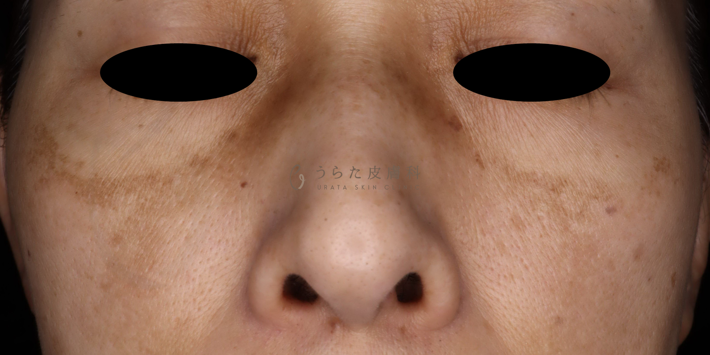 肝斑のゼオスキン治療前